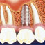 Implanted Dental Crowns
